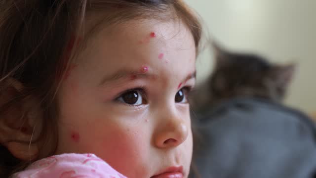 Toddler girl with chickenpox measles on the body. Varicella virus childhood contagious disease. Itchy red blisters, fever, pain symptoms.