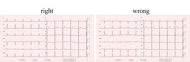 ECG comparison of correct and incorrect electrode positioning vector art illustration