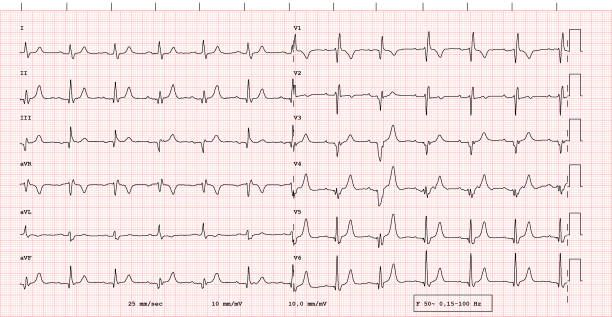 ECG example of a pacemaker rhythm vector art illustration