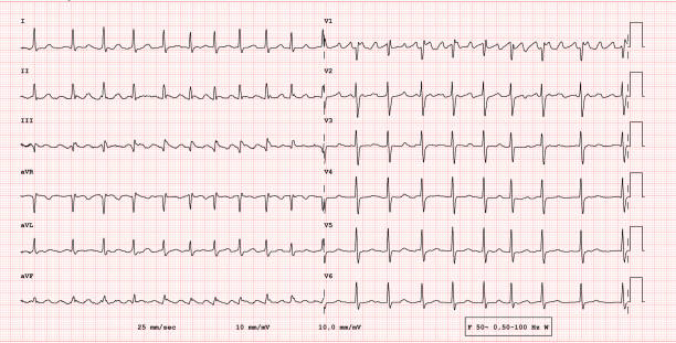 illustrations, cliparts, dessins animés et icônes de exemple ecg d’un flottement pathologique et auriculaire - fréquence cardiaque