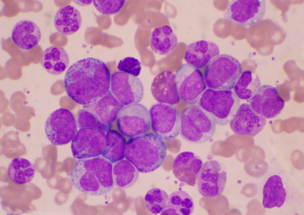istock Mixed stage white blood cell on red cells background.Leukemia concept. 1315623213