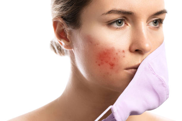 istock Maskne - acne breakouts from wearing a face mask 1315696364