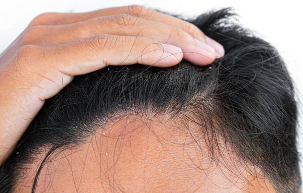 istock Man with dandruff in his hair on white background, closeup 1315810517