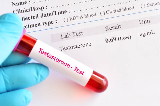 Abnormal low testosterone hormone test result Abnormal low testosterone hormone test result with blood sample tube estrogen photos stock pictures, royalty-free photos & images
