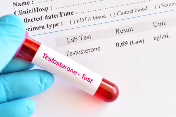 abnormal low testosterone hormone test result - low imagens e fotografias de stock