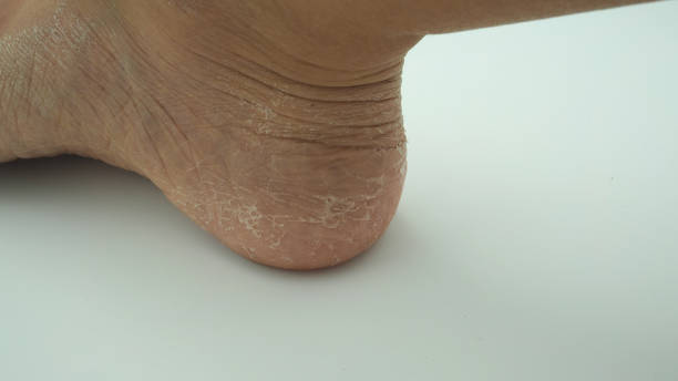 istock Foot skin is peeling with white background. 1315999532