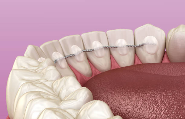 istock Retainers dental installed after braces treatment, Medically accurate dental 3D illustration 1316019911
