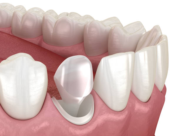istock Stump pin tab on canaine tooth. Medically accurate dental 3D illustration 1316019913