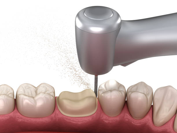 proceso de preparación molar para la colocación de corona dental. ilustración 3d médicamente precisa - handpiece fotografías e imágenes de stock