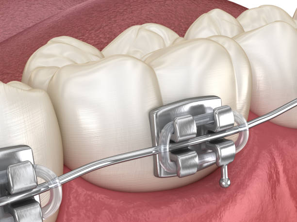 istock Healthy Teeth with metal braces, Macro view. Medically accurate dental 3D illustration 1316019949
