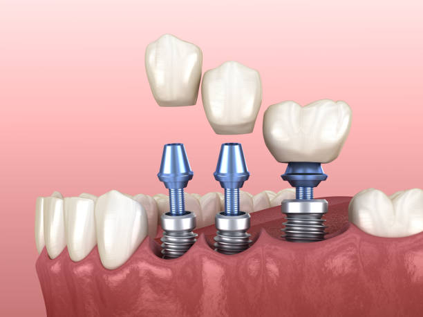 istock 3 tooth crowns placement over 3 implants - concept. 3D illustration of human teeth and dentures 1316019953
