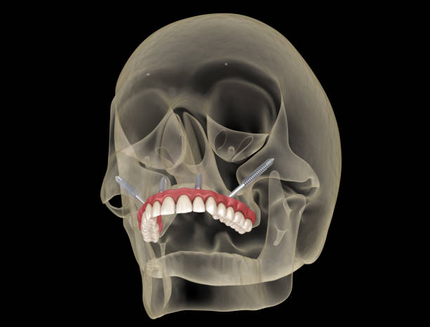 челюстно-максиллярный протез поддерживается зигоматических имплантатов. медицинская точная 3d иллюстрация человеческих зубов и зубных пр� - implantat стоковые фото и изображения