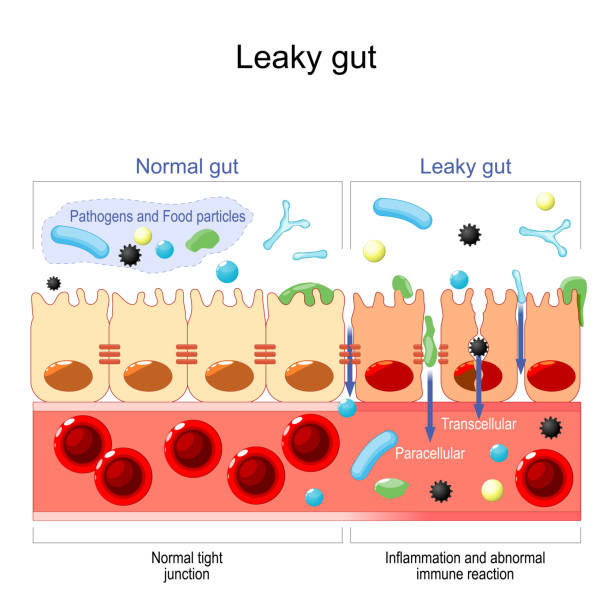 leaky gut leaky gut. cells on gut lining held tightly together. in intestine with celiac disease and gluten sensitivity these tight junctions come apart. autoimmune disorder. Vector illustration digestive illness stock illustrations