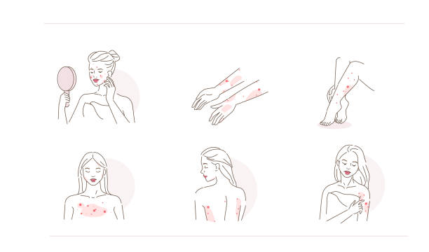 acne and allergy Beauty Girl Have Allergy and Acne Skin Problems. Woman Scratching her Body and Face with Hand. Allergic Dermatitis, Eczema or Nettle Rash with Itch Symptoms. Flat Line Cartoon Vector Illustration. back scratch stock illustrations