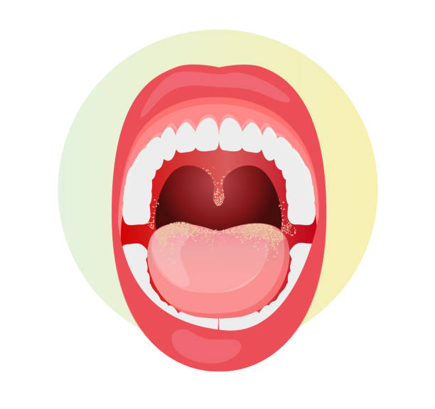 offener mund mit pilzinfektion auf zunge - lager-illustration - geöffneter mund stock-grafiken, -clipart, -cartoons und -symbole