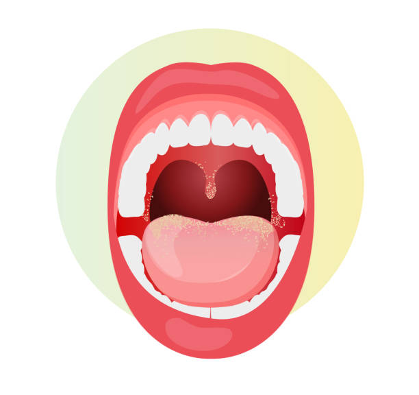 ilustrações de stock, clip art, desenhos animados e ícones de open mouth with fungal infection on tongue - stock illustration - mouth open