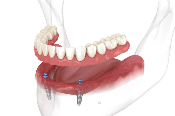 mandibular removable prosthesis all on 2 system supported by implants with ball attachments. medically accurate dental 3d illustration - implantat imagens e fotografias de stock