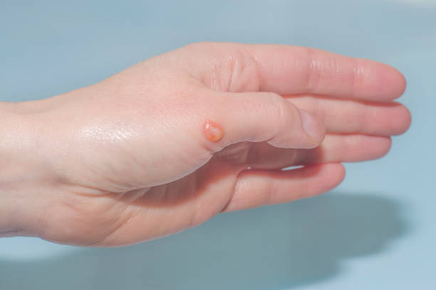 istock a blister on the hand after a burn 1316303889