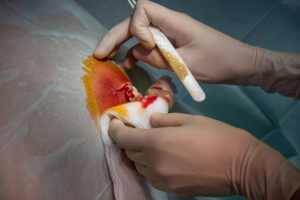 in the operating room the abscess of a patient is operated by a doctor in an operating room the abscess of a patient is operated by a doctor chest tattoo pain stock pictures, royalty-free photos & images