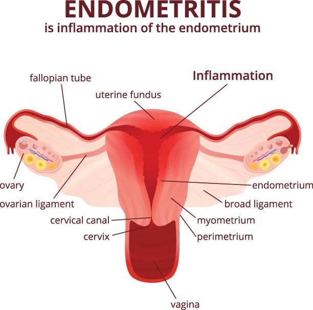 ženský reprodukční systém - endometritida ilustrace stock ilustrace