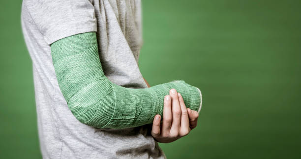foto cercana del brazo roto con yeso verde - brazo enyesado fotografías e imágenes de stock