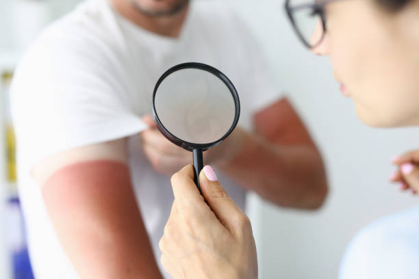 istock Doctor examining sunburns on patient arm using magnifying glass closeup 1316408250