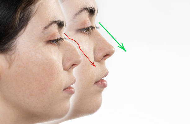 rhinoplasty. two female faces close-up showing the result before and after rhinoplasty. side view. white background. copy space - nose job imagens e fotografias de stock