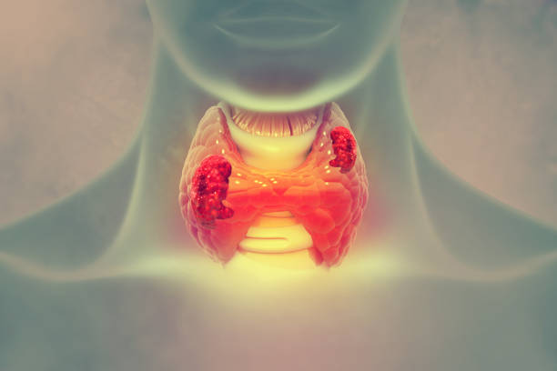 cancro alla tiroide. mostrando ghiandola tiroidea con tumore. illustrazione 3d - thyroid gland foto e immagini stock