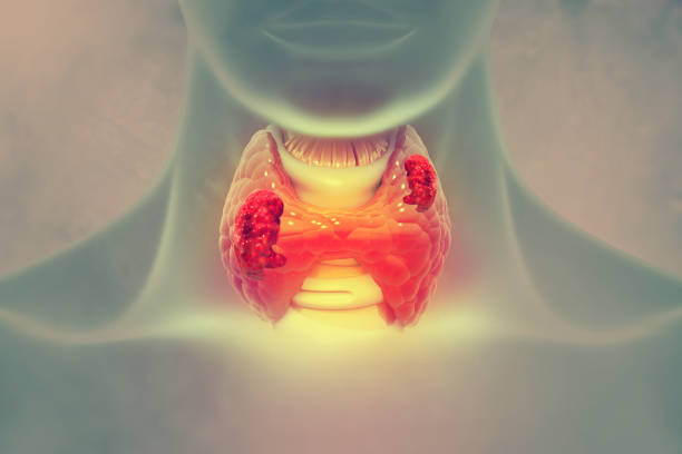 Thyroid gland cancer. showing thyroid gland with tumor. 3d illustration Thyroid gland cancer. showing thyroid gland with tumor. 3d illustration thyroid gland stock pictures, royalty-free photos & images