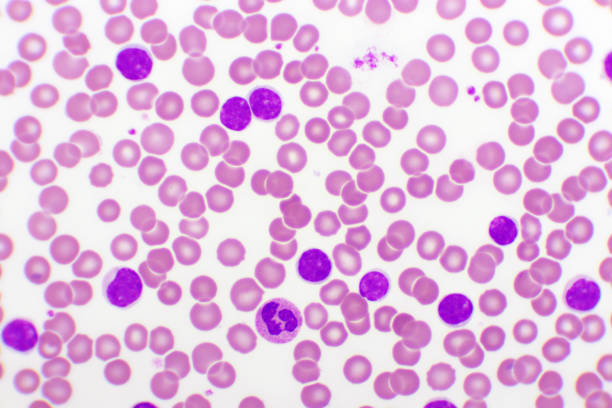 istock Acute lymphocytic leukemia or ALL cells in blood smear 1316467480