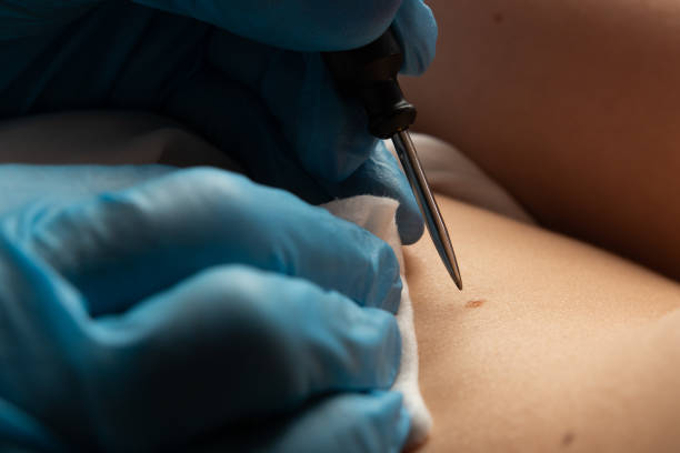 istock Removing a mole on the body close-up 1316491230