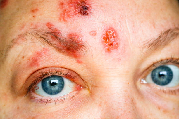 Shingles on the Face and Around the Eye, Called ophthalmic herpes zoster or herpes zoster ophthalmicus The shingles rash appearing on the face and around the eyes is called ophthalmic herpes zoster or herpes zoster ophthalmicus. pox stock pictures, royalty-free photos & images