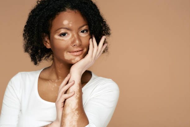 Young woman demonstrates her skin spots on her hands and face with vitiligo Young woman demonstrates her skin spots on her hands and face with vitiligo melanin photos stock pictures, royalty-free photos & images
