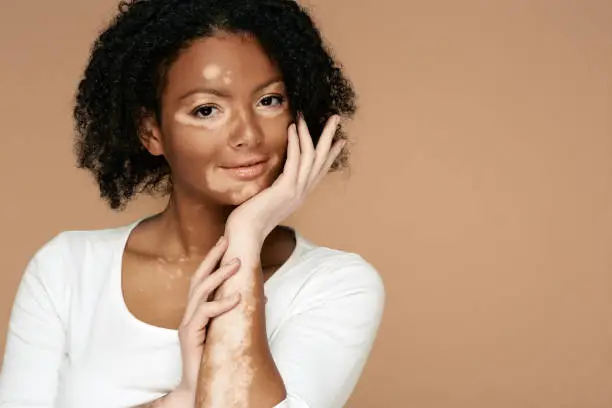Photo of Young woman demonstrates her skin spots on her hands and face with vitiligo