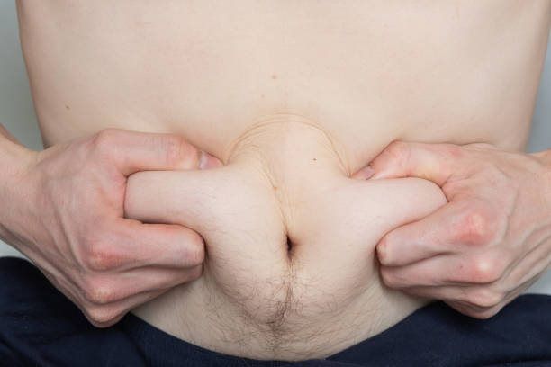 hombre sostiene pliegues de grasa en su estómago con las manos cerca - hairy men abdomen belly button fotografías e imágenes de stock
