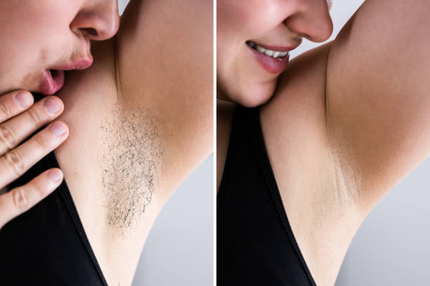 istock Before After Laser Hair Removal 1316932895