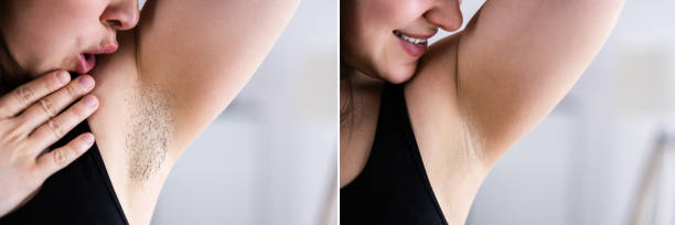 istock Before After Laser Hair Removal 1316932902