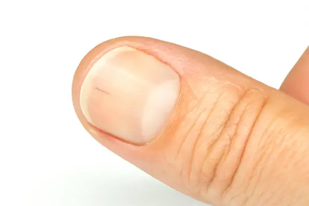 Photo of Thumb fingernail with sliver. Splinter under the nail close-up.