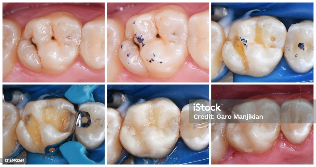 tooth esthetic restoration with light cure composite Anticipation Stock Photo