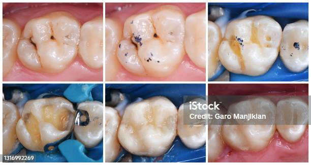 Tooth Esthetic Restoration With Light Cure Composite Stock Photo - Download Image Now