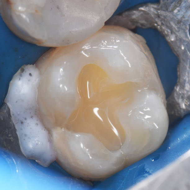 istock tooth cavity treatment with light cure composite 1317140111