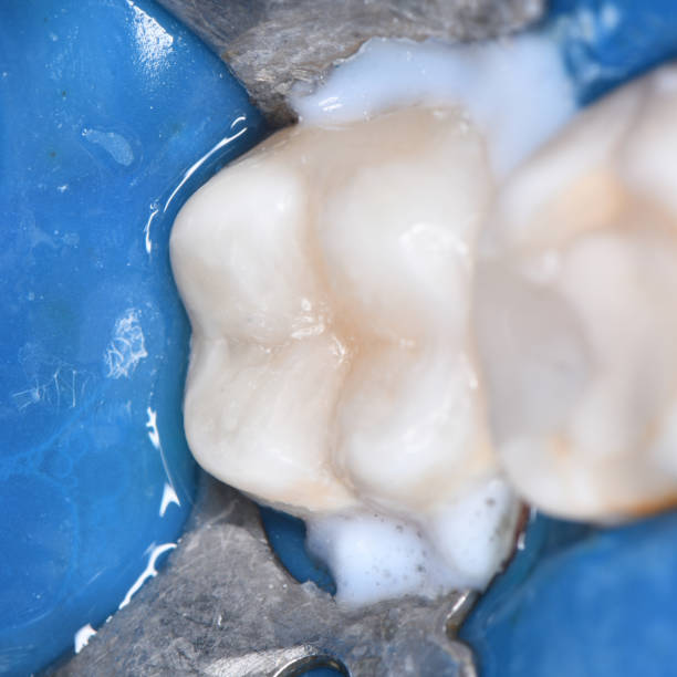 istock tooth cavity treatment with light cure composite 1317140277
