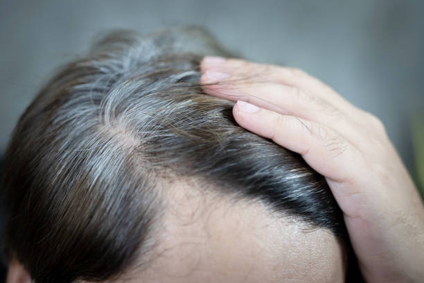 istock A man has hair growth, he has hair loss problems. Dry scalp, dandruff 1317196505