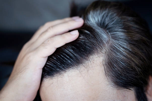 un homme a la croissance des cheveux, il a des problèmes de perte de cheveux. cuir chevelu sec, pellicules - cheveux blancs photos et images de collection