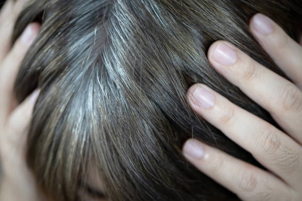 istock A man has hair growth, he has hair loss problems. Dry scalp, dandruff 1317196519