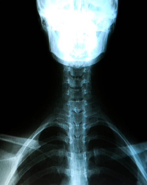 crânio e cervical raios-x de danificado pescoço - thoracic vertebrae - fotografias e filmes do acervo