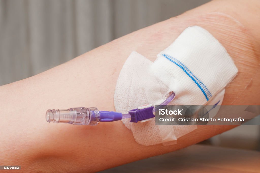 Picc (Peripherally Inserted Central Catheter) in the arm of a young woman. Picc can be used for long-term chemotherapy, antibiotic therapy, or total parenteral nutrition. Catheter Stock Photo