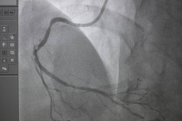 koronares angiogramm , medizinisches röntgen für herzerkrankungen. koronare herzkrankheit. - human heart heart attack x ray image chest stock-fotos und bilder