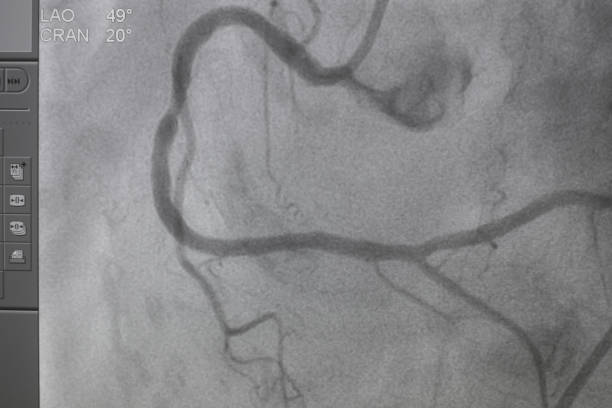 koronares angiogramm , medizinisches röntgen für herzerkrankungen. koronare herzkrankheit. - human heart heart attack x ray image chest stock-fotos und bilder