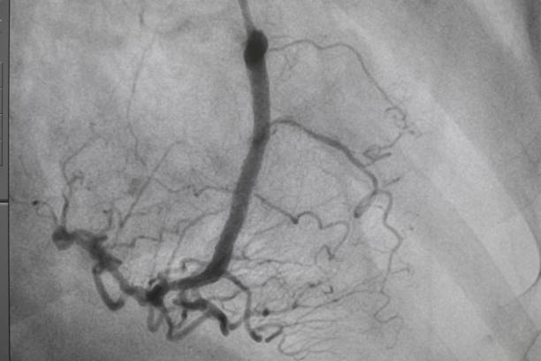 koronares angiogramm , medizinisches röntgen für herzerkrankungen. koronare herzkrankheit. - human heart heart attack x ray image chest stock-fotos und bilder